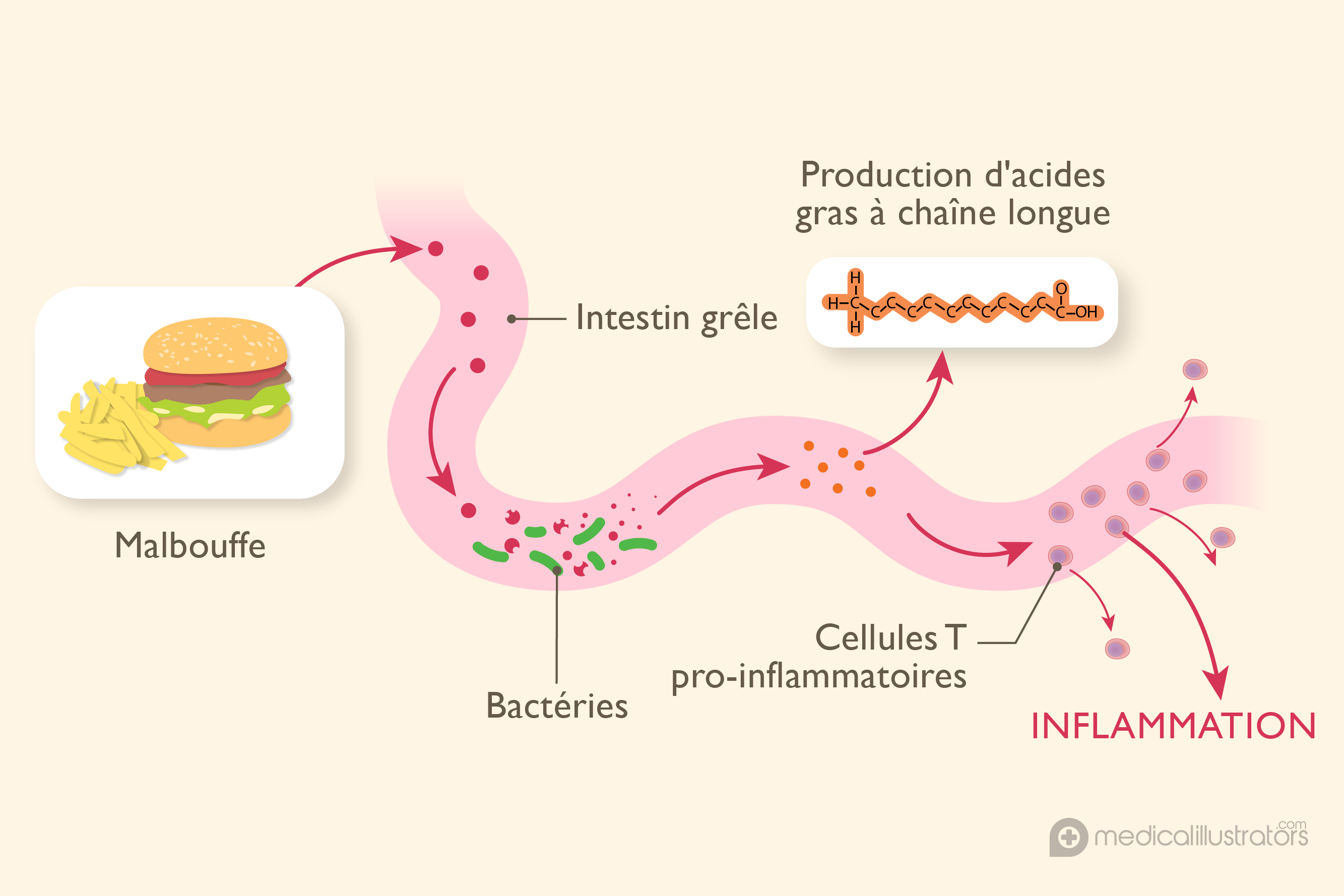 Influence de l?alimentation et des bactéries intestinales sur la sclérose en plaques