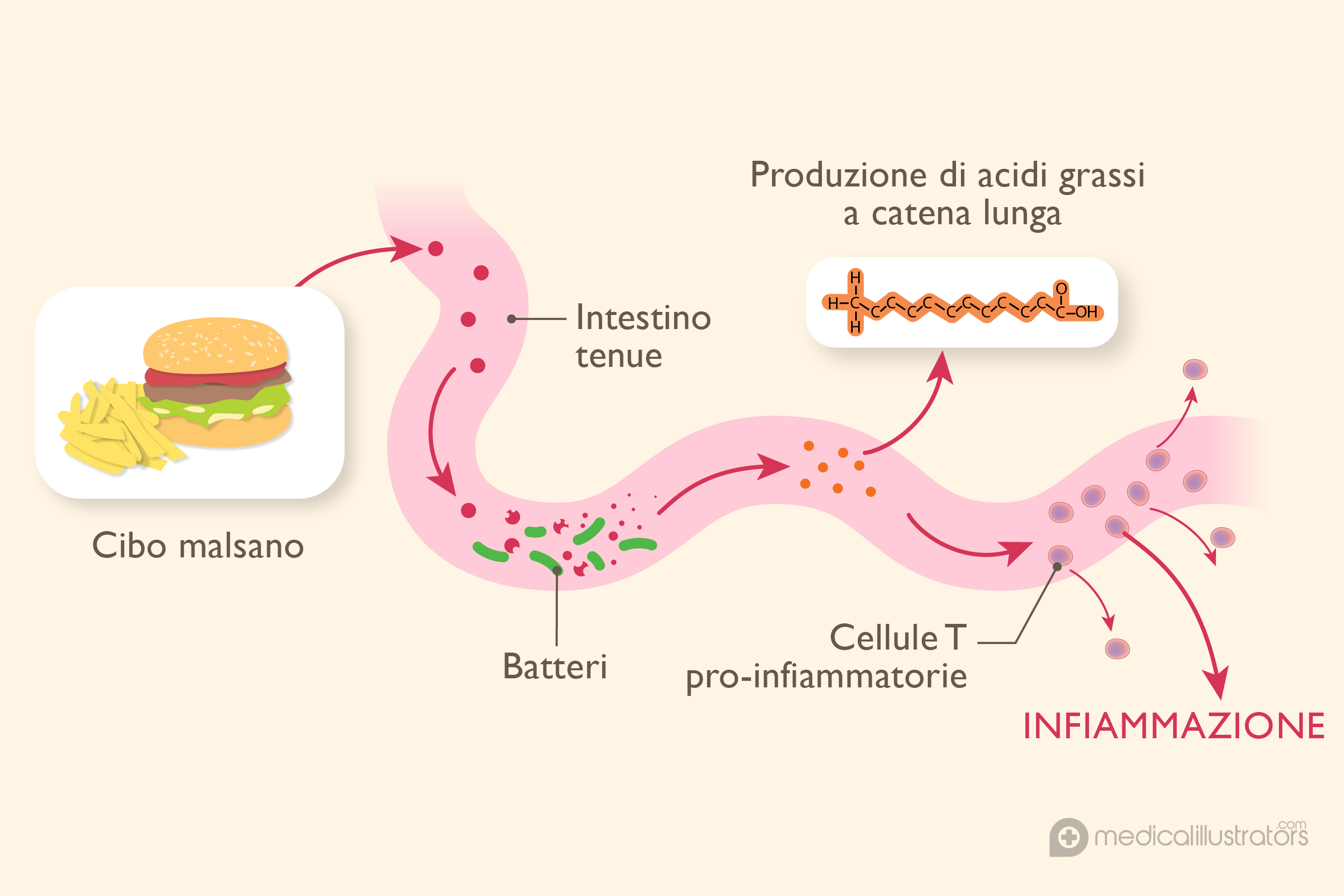 In base a sperimentazioni recenti, i batteri presenti nel nostro intestino e, in modo più specifico gli acidi grassi derivati dagli alimenti che assumiamo, potrebbero avere un'influenza sulla sclerosi multipla (SM).